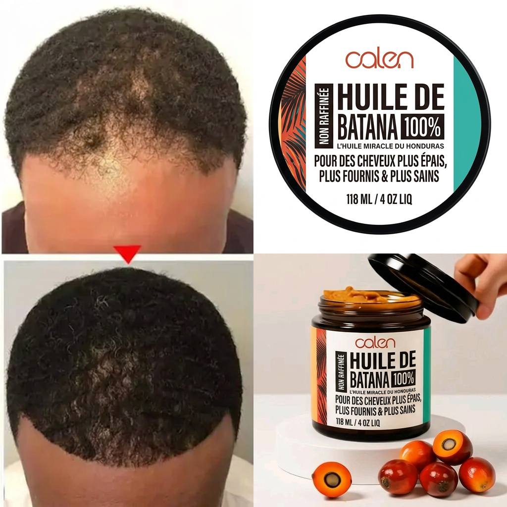 Stoppez la chute de cheveux et faites repousser vos tempes dégarnies en 14 jours — sans traitement chimique. (BN)